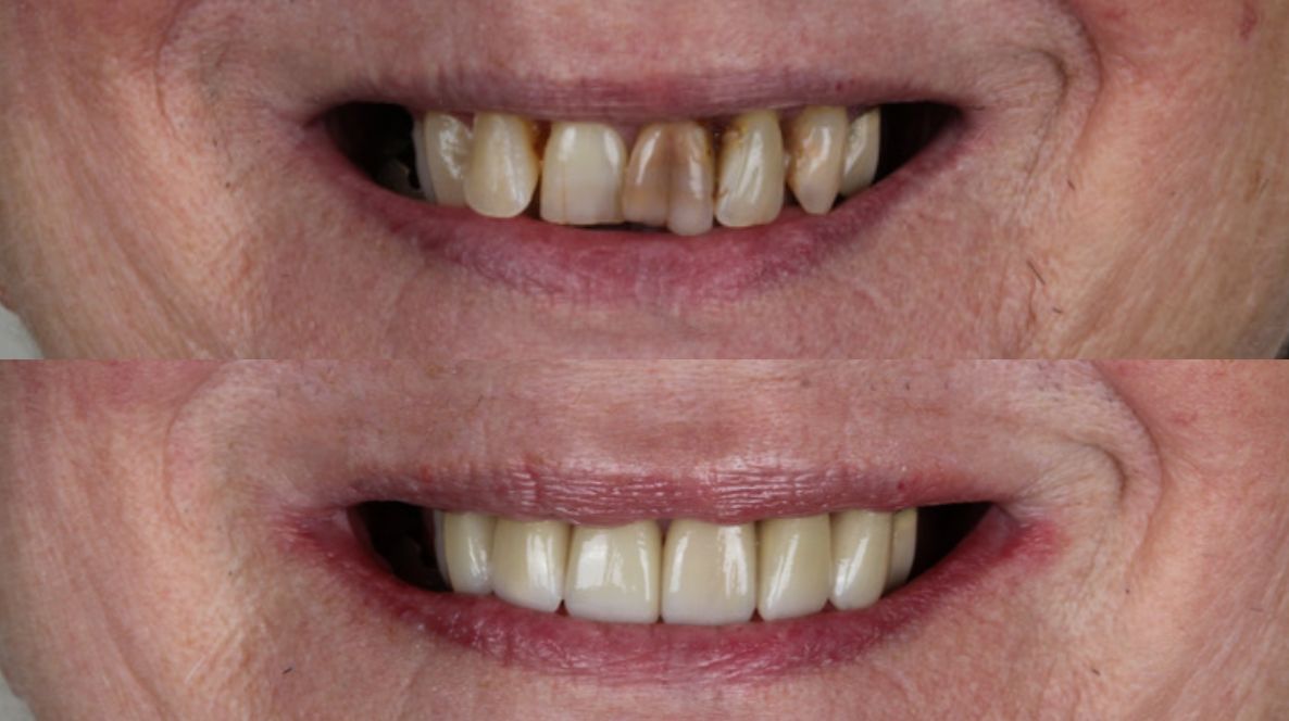 Lente de Contato Dental