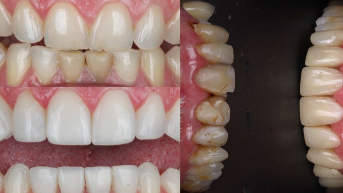 Facetas em Resina Composta