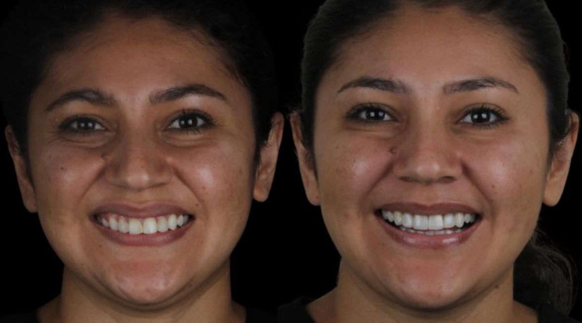 Facetas em Resina Composta