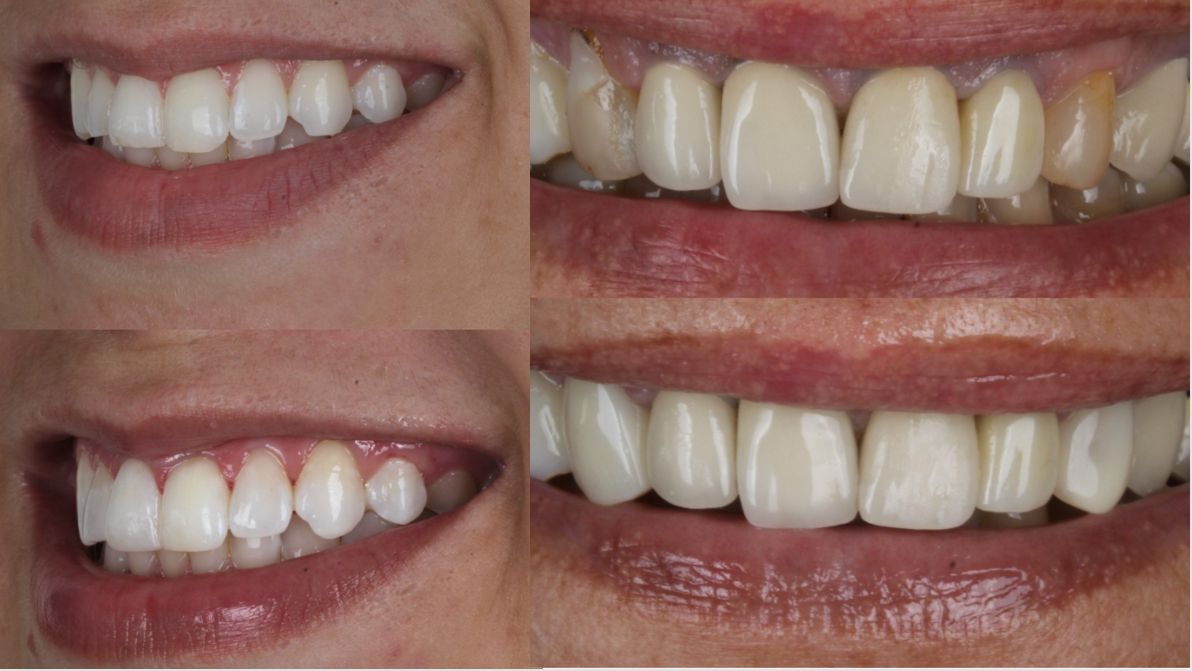 Facetas em Resina Composta